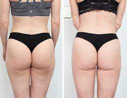Perfect Body Cellulite - kde koupit - Heureka - v lékárně - Dr Max - zda webu výrobce